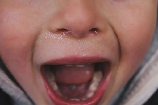 Close-up of a young child with lips apart and a congested nose, a common mouth breathing posture